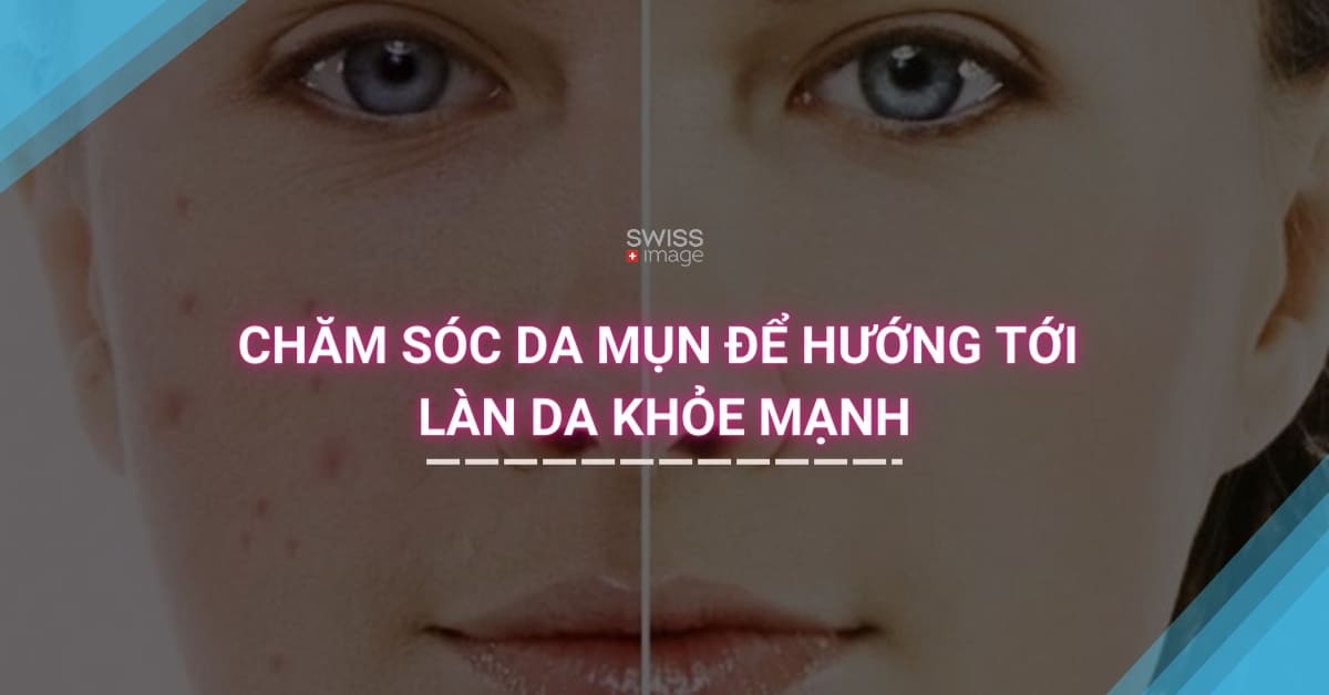 Chăm sóc da mụn để hướng tới làn da khỏe mạnh