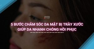 5 Bước Chăm Sóc Da Mặt Bị Trầy Xước Giúp Da Nhanh Chóng Hồi Phục