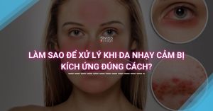 Làm Sao để Xử Lý Khi Da Nhạy Cảm Bị Kích Ứng Đúng Cách